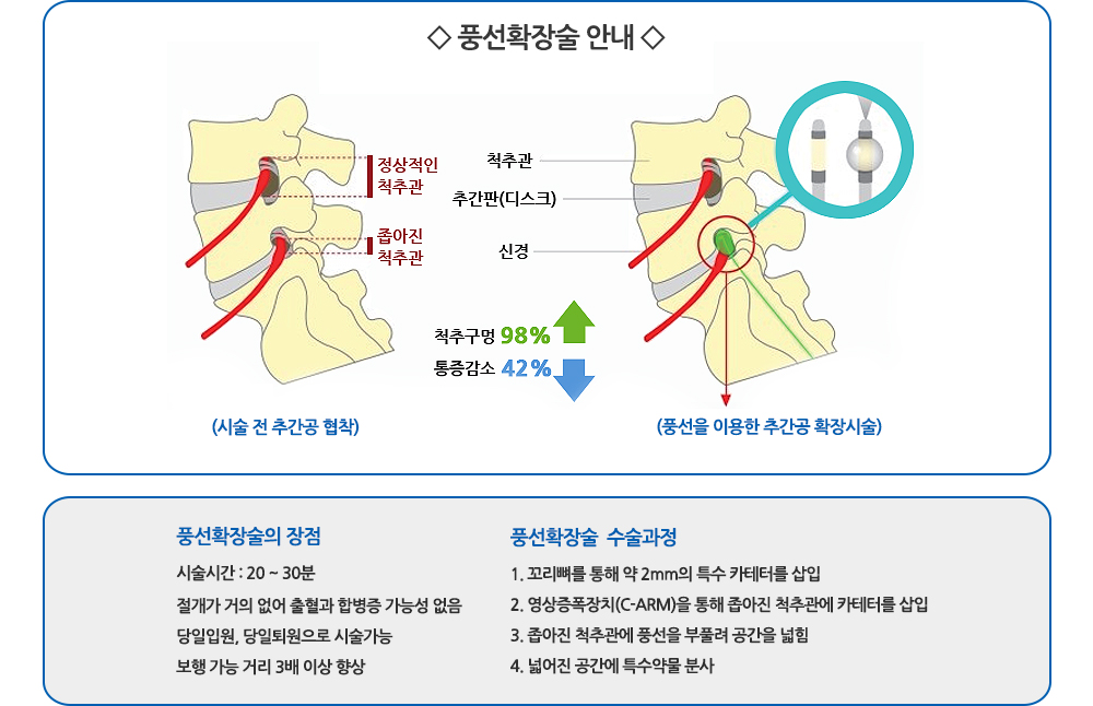 풍선확장술