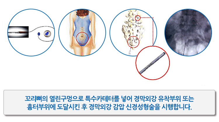 신경성형술