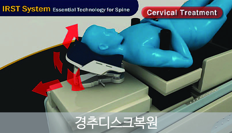 IRST의 적용대상 