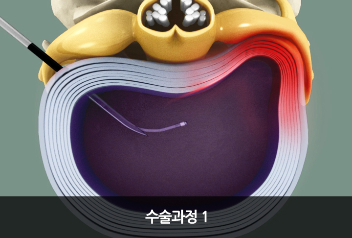 플라즈마 수핵감압술