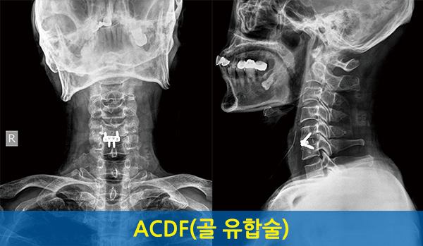 골 유합술