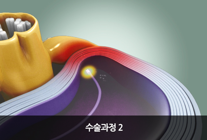 플라즈마 수핵감압술