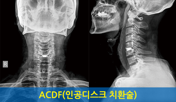 인공디스크 치환술