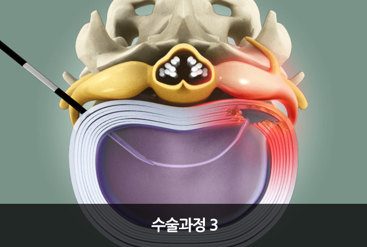 플라즈마 수핵감압술