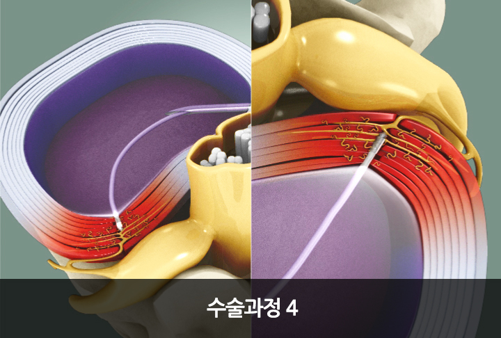플라즈마 수핵감압술