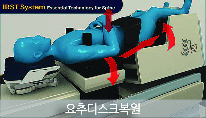 IRST의 적용대상 